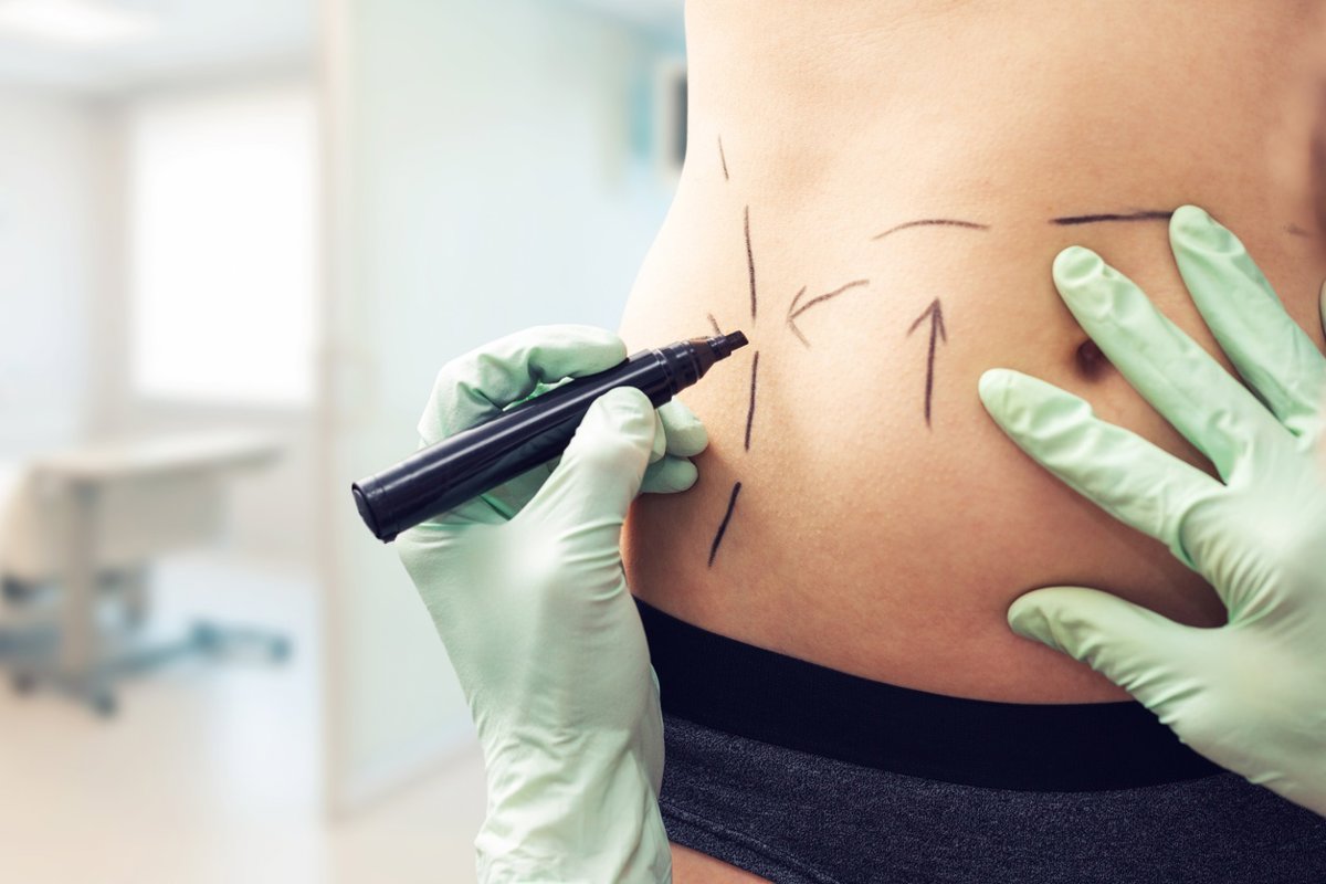 La liposuccion sert-elle à mincir ? Les six mythes à connaître