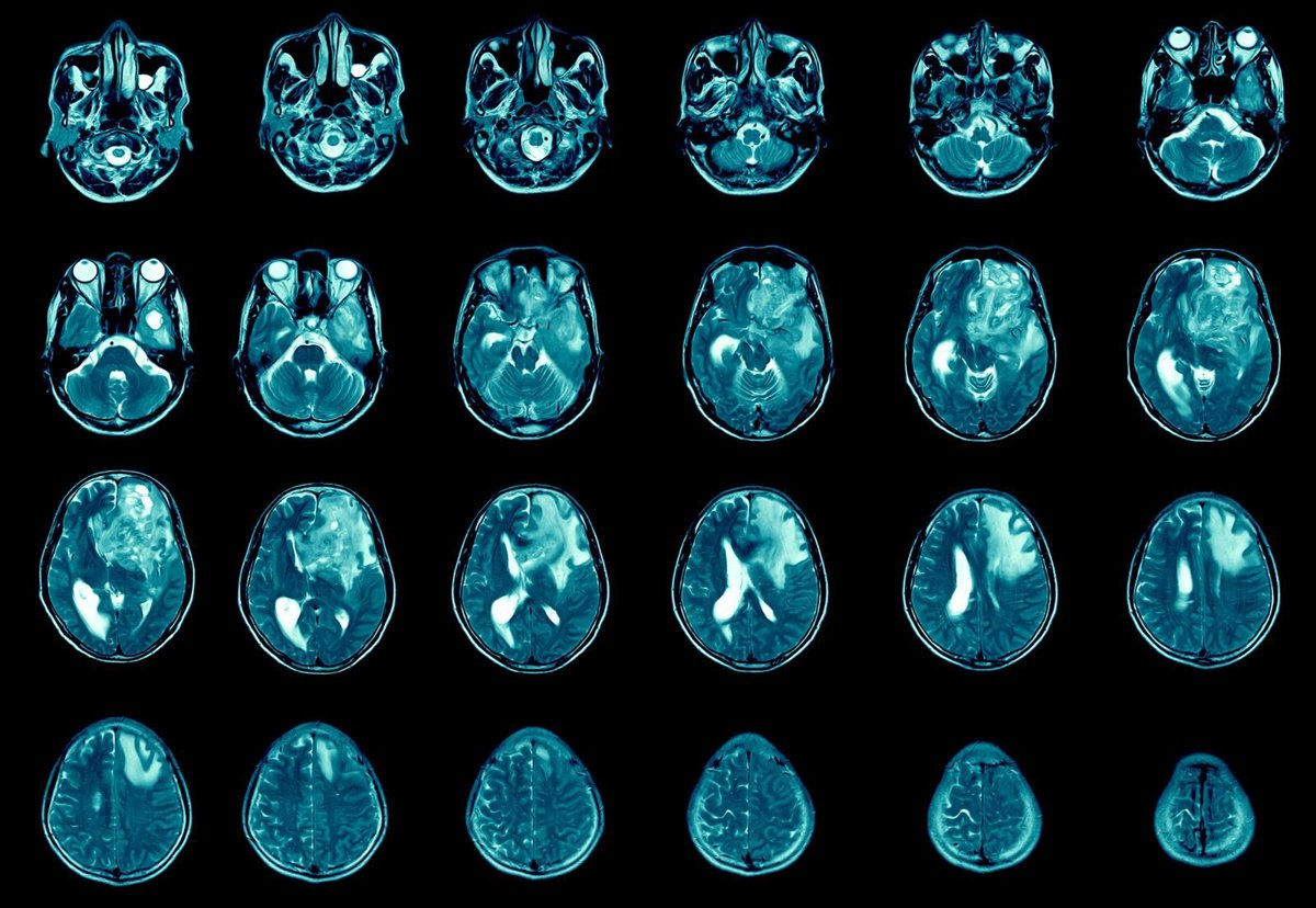 Implant expérimental pour améliorer l’accès des médicaments au cerveau après une chirurgie du glioblastome